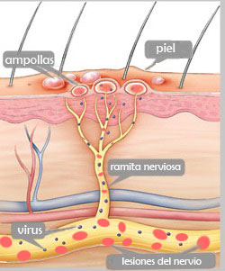 herpes