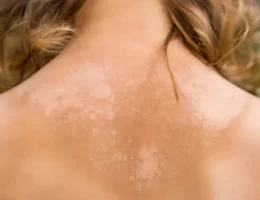 manchas solares
