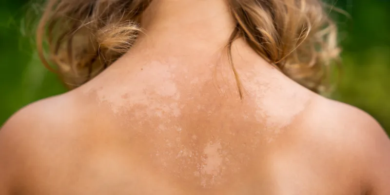 manchas solares